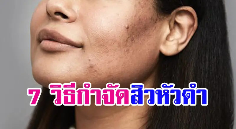 7 วิธีกำจัดสิวหัวดำและป้องกันการเกิดสิว เพื่อช่วยให้หน้ากลับมาเนียนใส !!